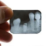 Are Dental Implants Right for You?